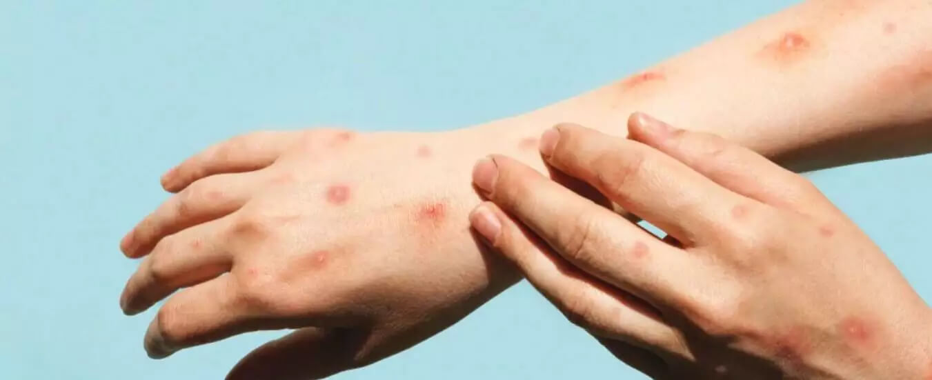 Capa OMS mantém alerta máximo para mpox devido ao aumento de casos e países afetados