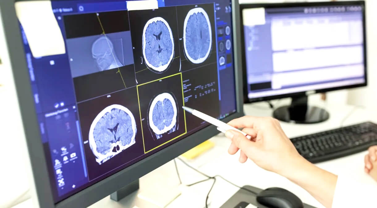 Capa Butantan testa tratamento contra Alzheimer com proteína da Merluza