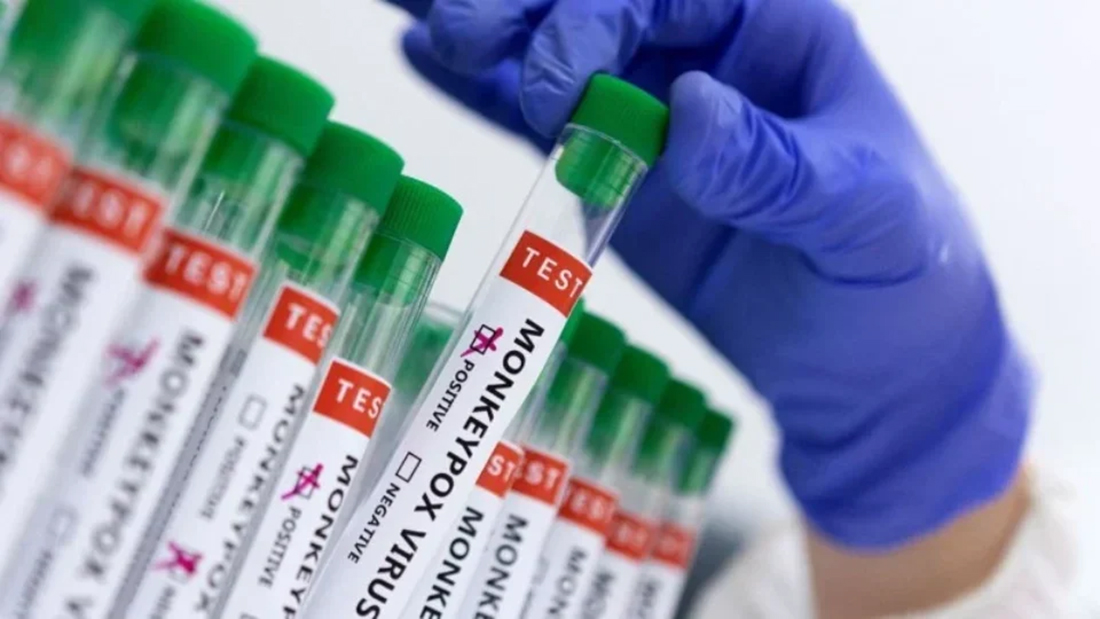 Capa Passo Fundo confirma mais dois casos de Mpox