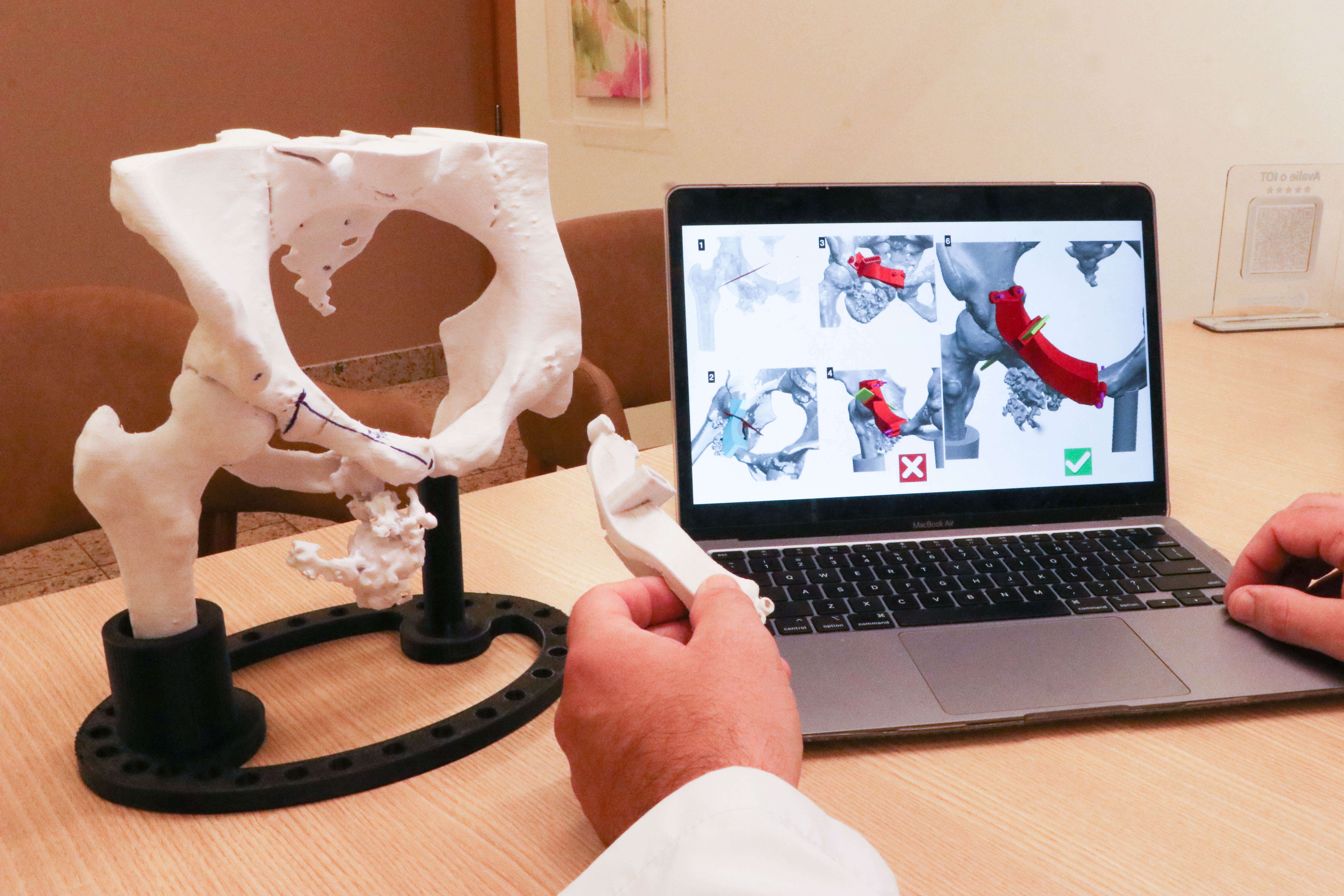 Capa Impressão 3D revoluciona procedimentos na área da ortopedia oncológica