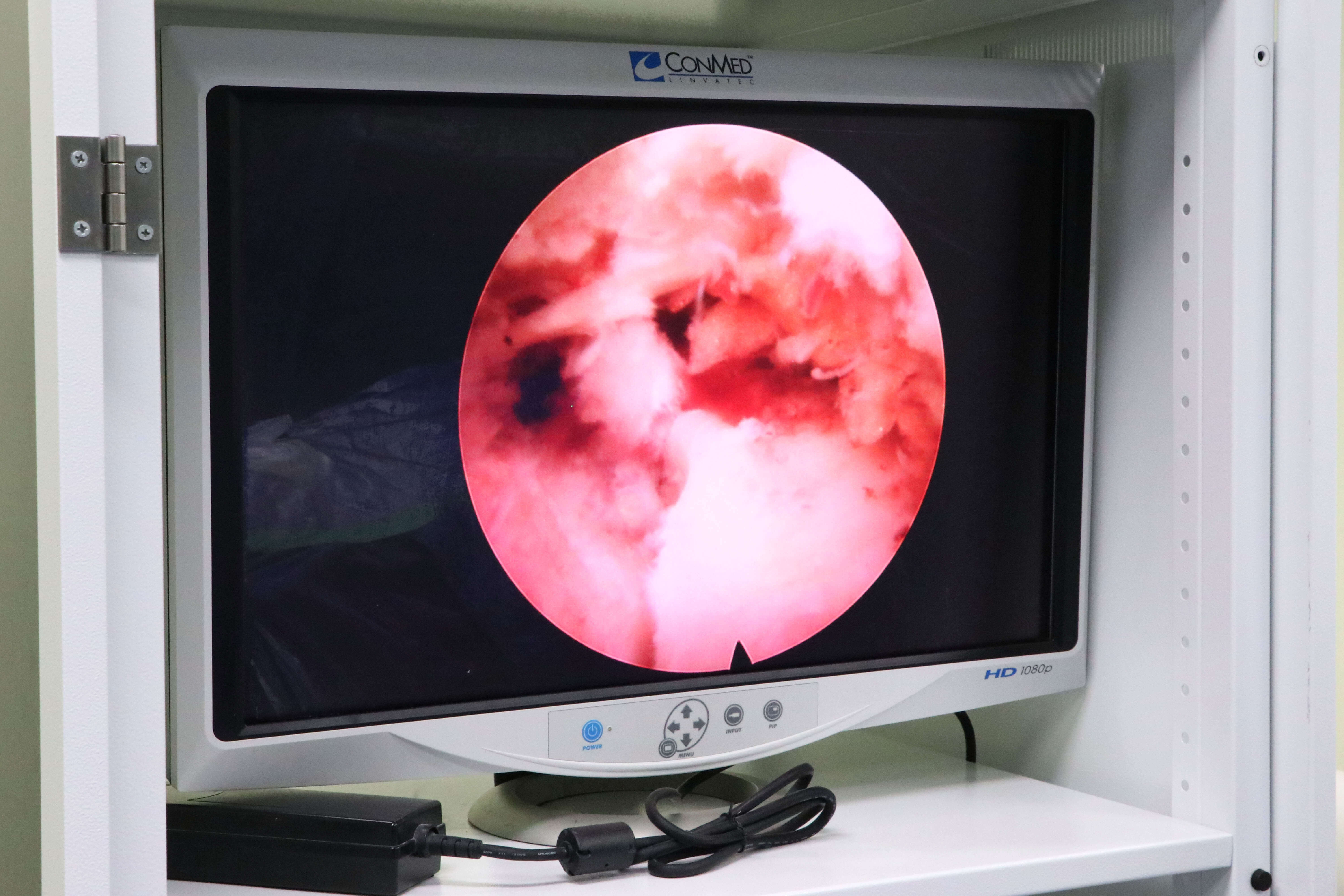Capa HSVP é referência no uso de videoendoscopia em cirurgias de coluna 