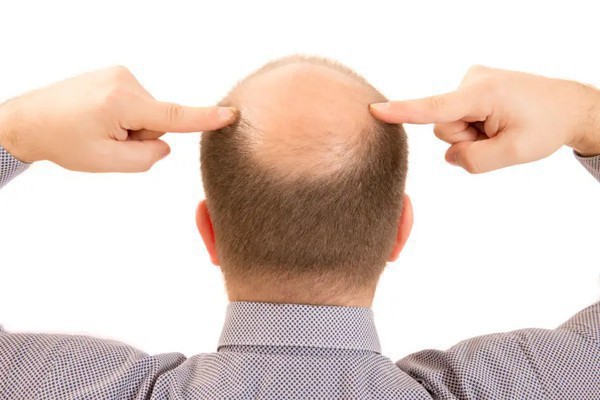 Capa Calvície: Anvisa não recomenda tratamento com minoxidil por via oral