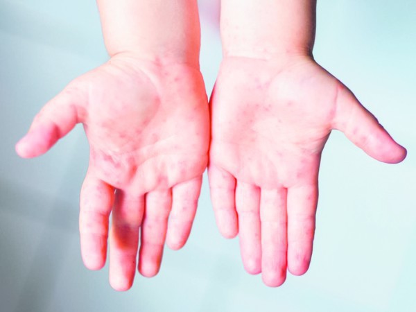 Capa Herpes zoster: vacinas podem prevenir a doença