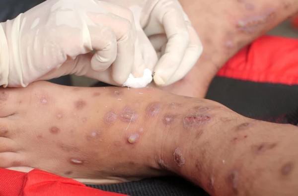 Capa Fachin autoriza campanha de prevenção à varíola do macaco