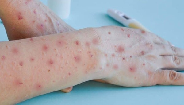Capa RS emite alerta epidemiológico sobre a varíola do macaco